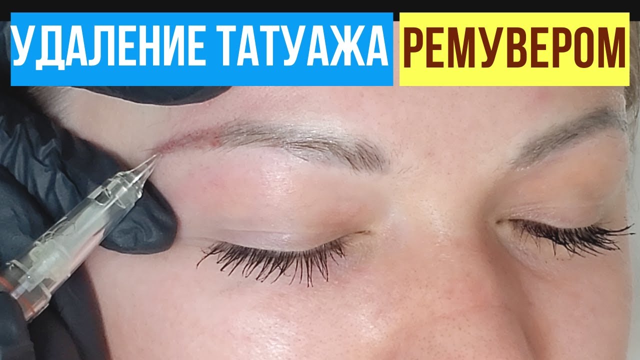 Удаление тату ремуваром