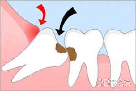 •	Удаление  зубов  мудрости  на нижней  и  верхней  челюстях  всех степеней слож. . фото 1