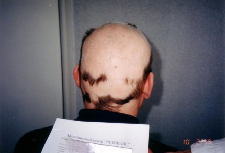 Лучший трихолог Украины.
Лечение алопеции (облысения) и выпадения волос.

Кли. . фото 6