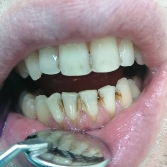 Чистка зубов ультрозвуком(снятие камней, мягкого и темного налета, полировка щет. . фото 2