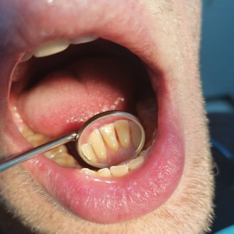 Чистка зубов ультрозвуком(снятие камней, мягкого и темного налета, полировка щет. . фото 4