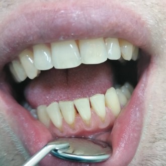 Чистка зубов ультрозвуком(снятие камней, мягкого и темного налета, полировка щет. . фото 5