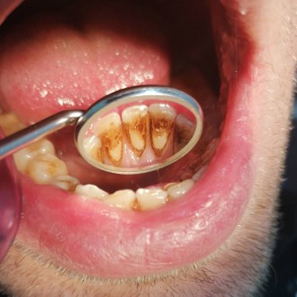 Чистка зубов ультрозвуком(снятие камней, мягкого и темного налета, полировка щет. . фото 3