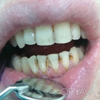 Чистка зубов ультрозвуком(снятие камней, мягкого и темного налета, полировка щет. . фото 1